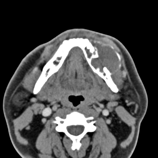 File:Ameloblastoma (Radiopaedia 33677-34806 Axial non-contrast 24).png