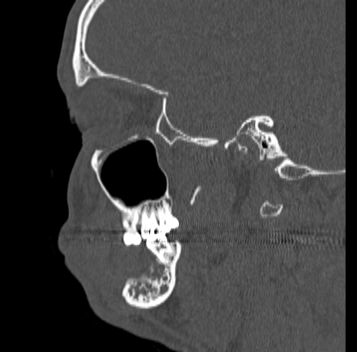 Ameloblastoma (Radiopaedia 77750-89997 Sagittal bone window 52).jpg