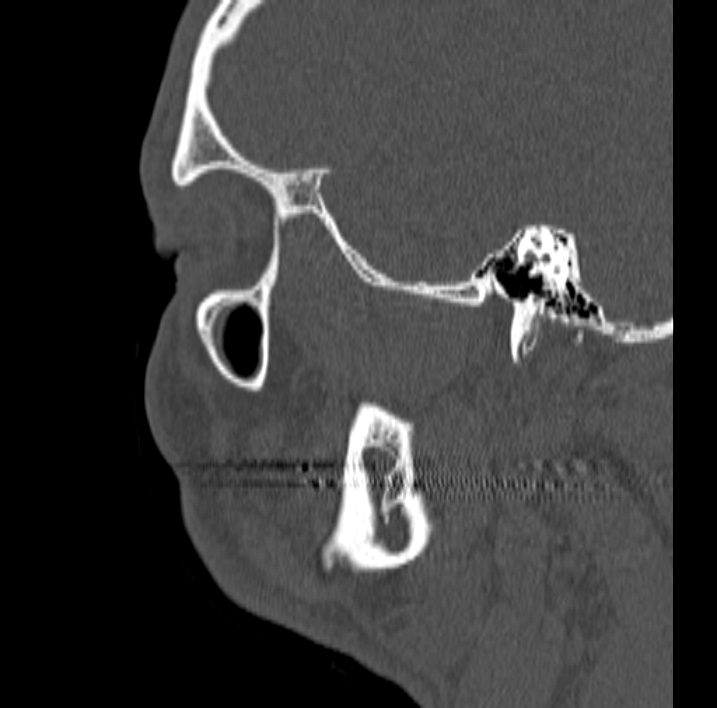 Ameloblastoma (Radiopaedia 77750-89997 Sagittal bone window 86).jpg