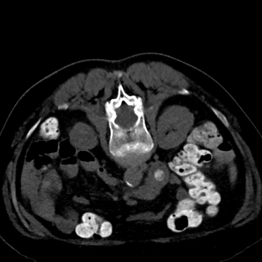 Ampullary adenocarcinoma (Radiopaedia 34013-35241 C 52).png