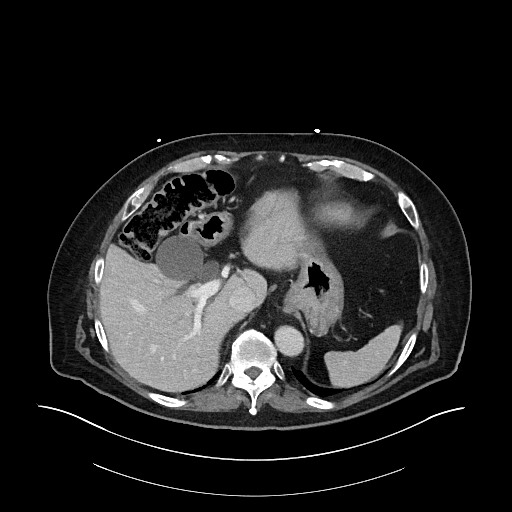 Ampullary adenocarcinoma (Radiopaedia 59373-66734 C 37).jpg