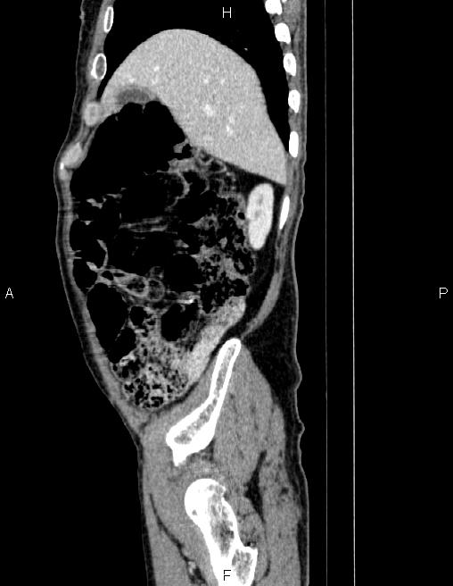 Ampullary adenocarcinoma (Radiopaedia 86093-102032 D 16).jpg