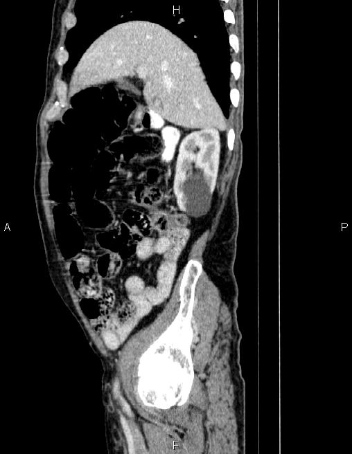 Ampullary adenocarcinoma (Radiopaedia 86093-102032 D 23).jpg