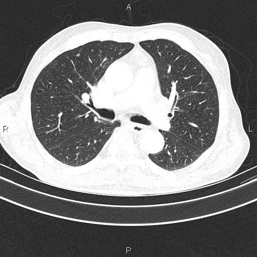Ampullary adenocarcinoma (Radiopaedia 86093-102033 Axial lung window 30).jpg