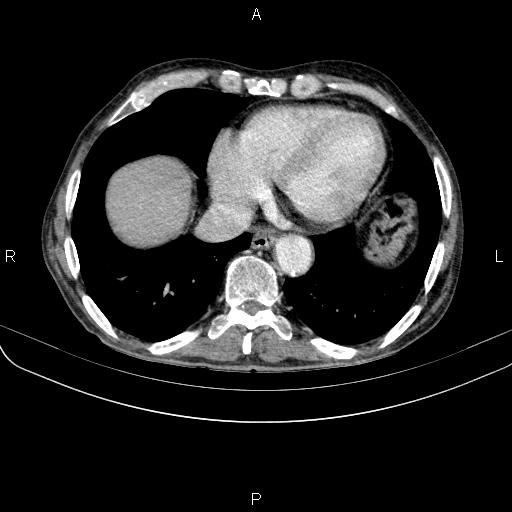 Ampullary adenocarcinoma (Radiopaedia 86093-102033 B 44).jpg
