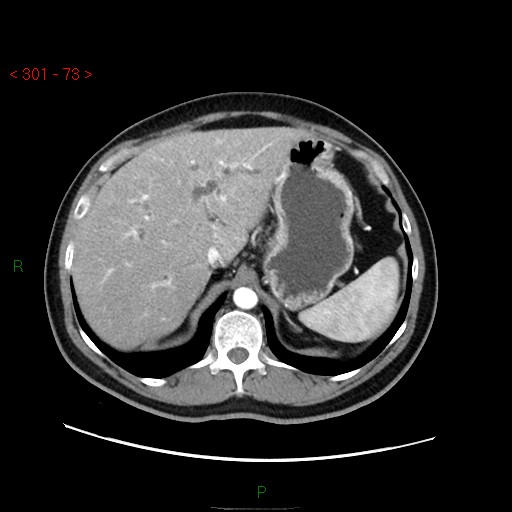 Ampullary carcinoma (Radiopaedia 56396-63056 B 19).jpg