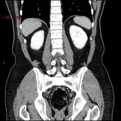 Ampullary carcinoma (Radiopaedia 56396-63056 E 71).jpg