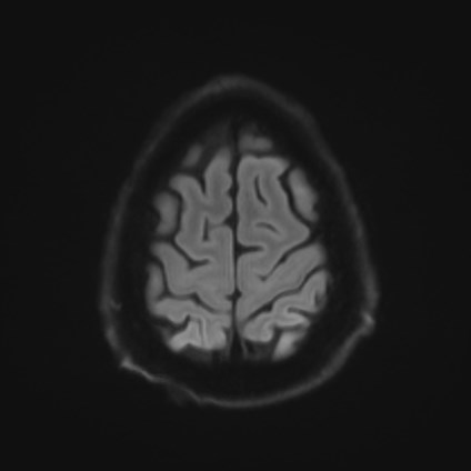 Amyotrophic lateral sclerosis (Radiopaedia 87352-103658 Axial DWI 53).jpg