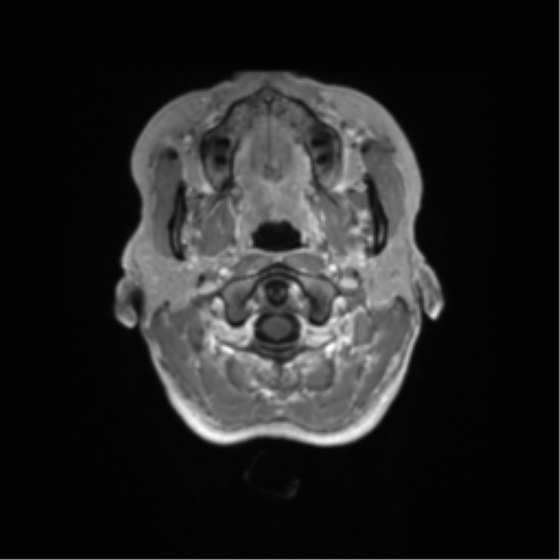 File:Anaplastic astrocytoma IDH mutant (Radiopaedia 50046-55341 Axial T1 C+ 2).png