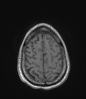 Anaplastic astrocytoma IDH wild-type (Radiopaedia 49984-55273 Axial T1 48).png