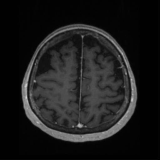 File:Anaplastic astrocytoma IDH wild-type (pseudoprogression) (Radiopaedia 42209-45276 Axial T1 C+ 112).png