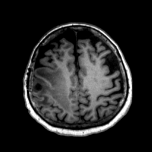 Anaplastic astrocytoma IDH wild-type (pseudoprogression) (Radiopaedia 42209-45277 Axial T1 97).png