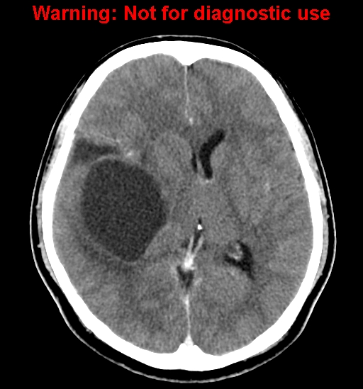 File:Anaplastic ganglioglioma (Radiopaedia 44921-48815 B 15).jpg