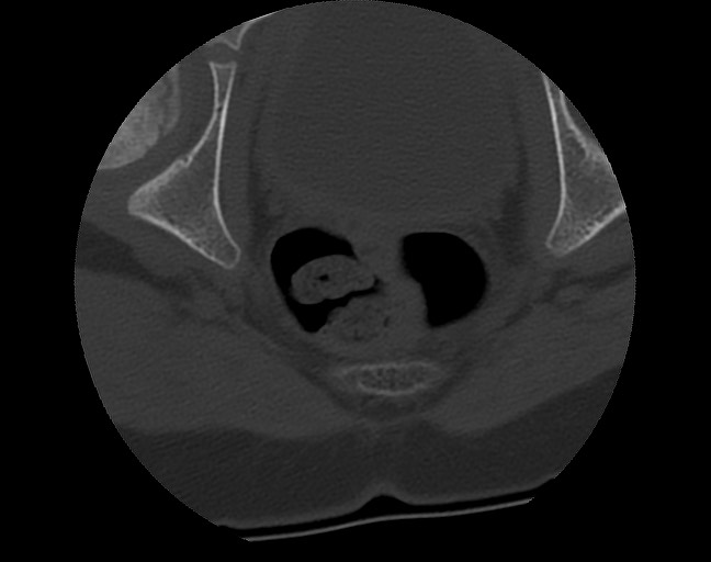 Aneurysmal bone cyst - sacrum (Radiopaedia 65190-74195 Axial bone window 46).jpg