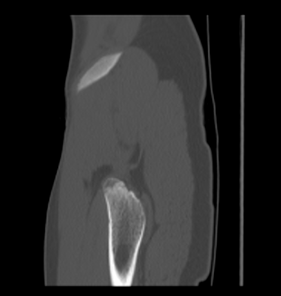 Aneurysmal bone cyst of ischium (Radiopaedia 25957-26094 Sagittal bone window 66).png