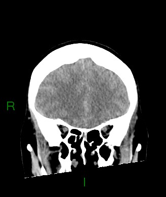 File:Aneurysmal subarachnoid hemorrhage with intra-axial extension (Radiopaedia 84371-99699 Coronal non-contrast 49).jpg