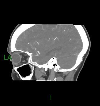 Aneurysmal subarachnoid hemorrhage with intra-axial extension (Radiopaedia 84371-99732 B 19).jpg