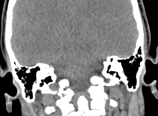 Angular dermoid cyst (Radiopaedia 88967-105790 Coronal non-contrast 81).jpg