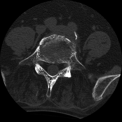 Ankylosing spondylitis complicated by fracture-dislocation (Radiopaedia 33583-34674 Axial non-contrast 127).jpg