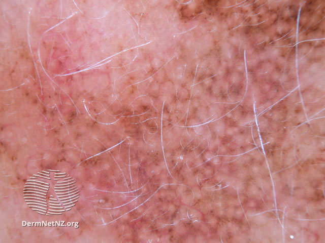 File:Annular granular pattern seen in dermoscopy of lentigo maligna (DermNet NZ doctors-dermoscopy-course-images-lm3).jpg