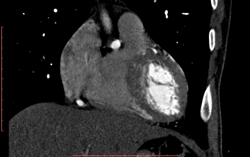 Anomalous left coronary artery from the pulmonary artery (ALCAPA) (Radiopaedia 70148-80181 B 93).jpg