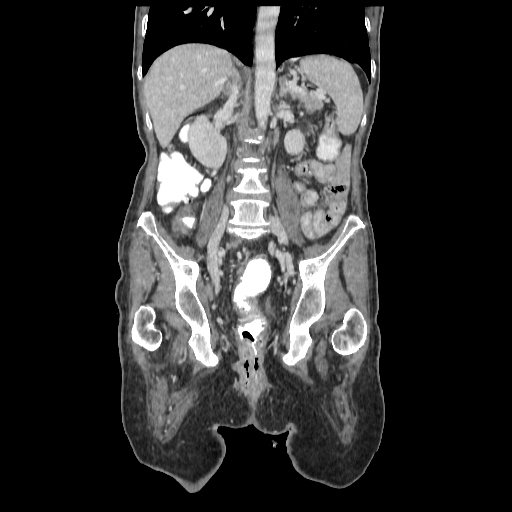 Anorectal carcinoma (Radiopaedia 44413-48064 B 50).jpg