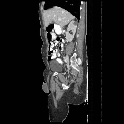 Anorectal carcinoma (Radiopaedia 44413-48064 C 35).jpg