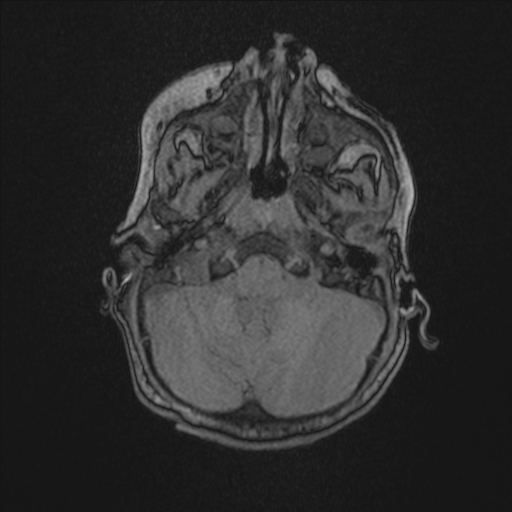 File:Anoxic brain injury (Radiopaedia 79165-92139 Axial MRA 41).jpg