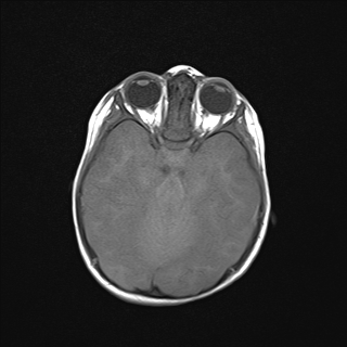 File:Anoxic brain injury (Radiopaedia 79165-92139 Axial T1 10).jpg