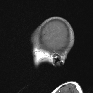 File:Anoxic brain injury (Radiopaedia 79165-92139 Sagittal T1 3).jpg