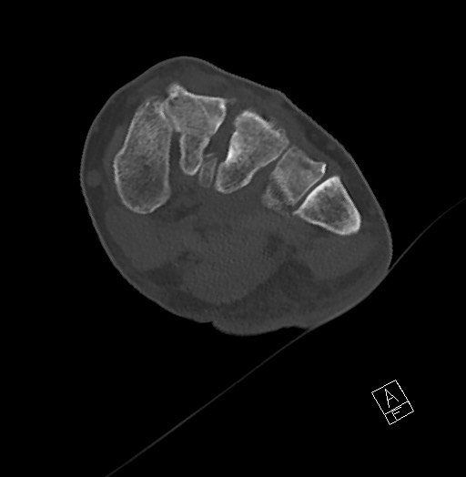 File:Anterior calcaneal process fracture (Radiopaedia 63353-71943 Axial bone window 78).jpg