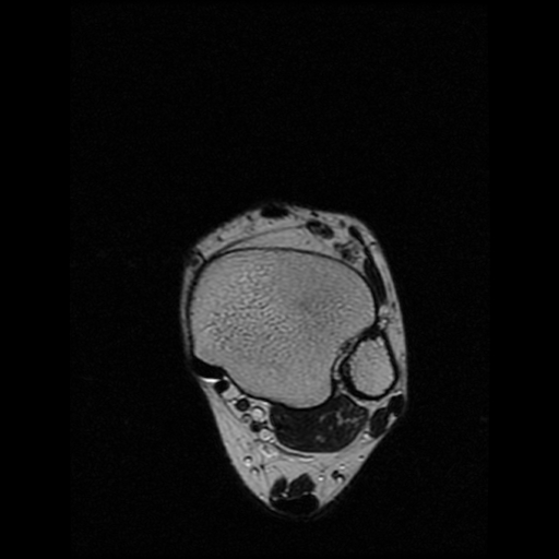 File:Anterior calcaneal process fracture (Radiopaedia 74654-85611 Axial T2 2).jpg
