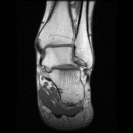 File:Anterior calcaneal process fracture (Radiopaedia 74654-85611 Coronal T1 15).jpg