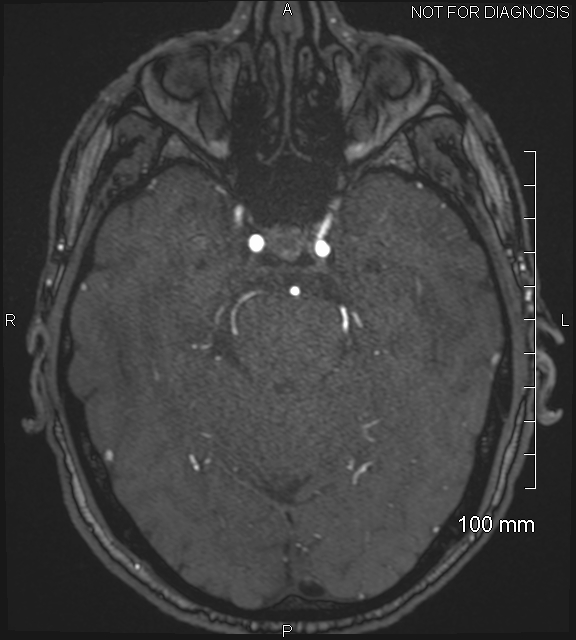 Anterior cerebral artery aneurysm (Radiopaedia 80683-94127 Axial MRA 78).jpg