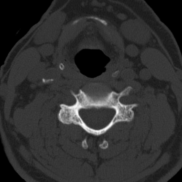 Anterior cervical postdiscectomy arthrodesis (Radiopaedia 32678-33646 Axial bone window 41).jpg