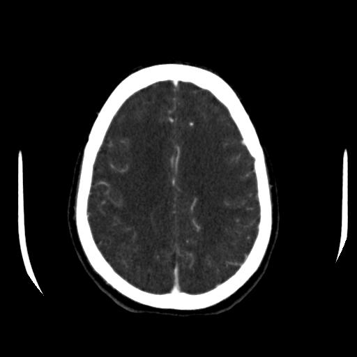 File:Anterior communicating artery aneurysm (Radiopaedia 16633-16335 A 33).jpg