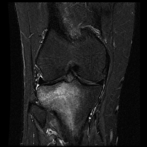 File:Anterior cruciate ligament avulsion fracture (Radiopaedia 58939-66193 Coronal STIR 11).jpg