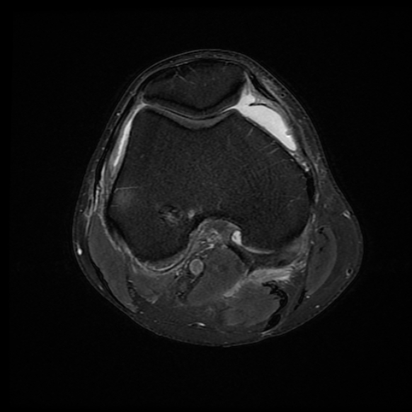 File:Anterior cruciate ligament graft tear and bucket-handle tear of medial meniscus (Radiopaedia 75867-87255 Axial PD fat sat 15).jpg