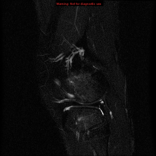File:Anterior cruciate ligament injury - partial thickness tear (Radiopaedia 12176-12515 Sagittal T2 fat sat 16).jpg