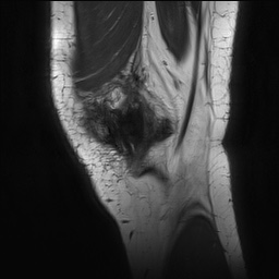 Anterior cruciate ligament rupture with Segond fracture (Radiopaedia 69043-78806 Sagittal PD 24).jpg