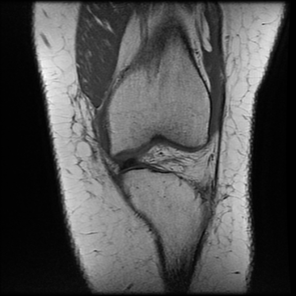 File:Anterior cruciate ligament tear, Wrisberg rip and bucket-handle tear of medial meniscus (Radiopaedia 75872-87266 Coronal T1 10).jpg