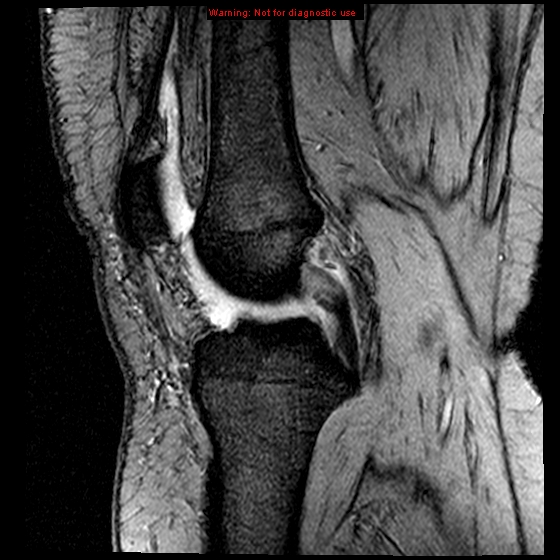 File:Anterior cruciate ligament tear (Radiopaedia 12329-12612 A 12).jpg