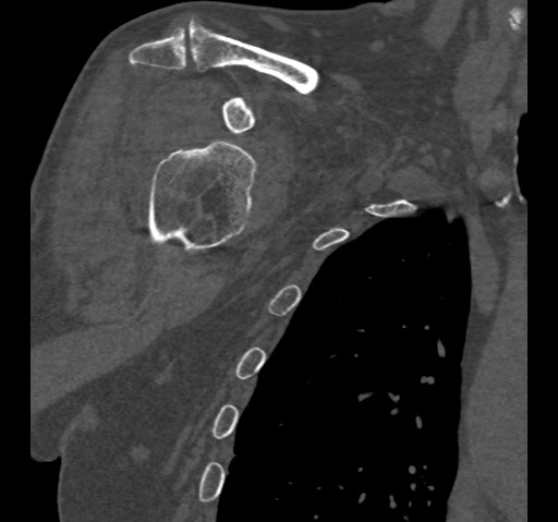 Anterior glenohumeral dislocation with Hill-Sachs lesion (Radiopaedia 62877-71249 Coronal bone window 26).jpg