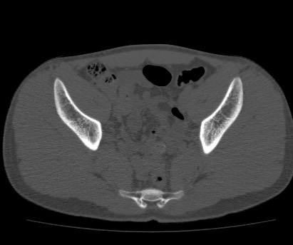 Anterior inferior iliac spine avulsion fracture (Radiopaedia 81312-94999 Axial bone window 40).jpg