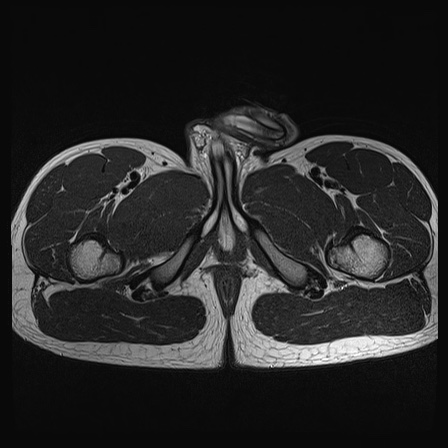 File:Anterior inferior iliac spine avulsion fracture (Radiopaedia 81312-95000 Axial T2 1).jpg