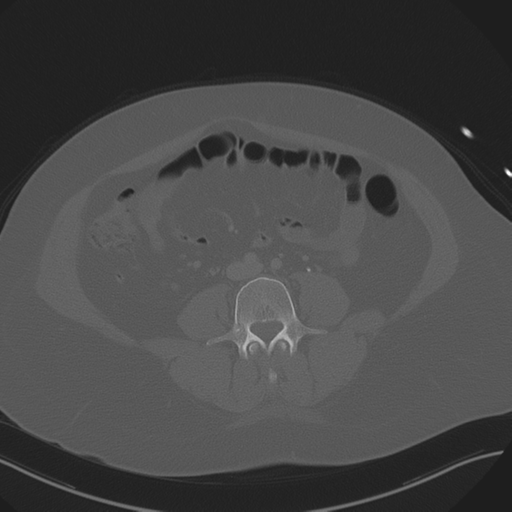 Anterior superior iliac spine avulsion fracture (Radiopaedia 44541-48244 Axial bone window 60).png