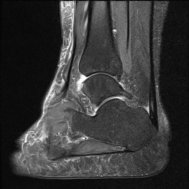 File:Anterior talofibular ligament injury - rupture with soft-tissue impingement (Radiopaedia 38765-40928 Sagittal PD fat sat 13).jpg