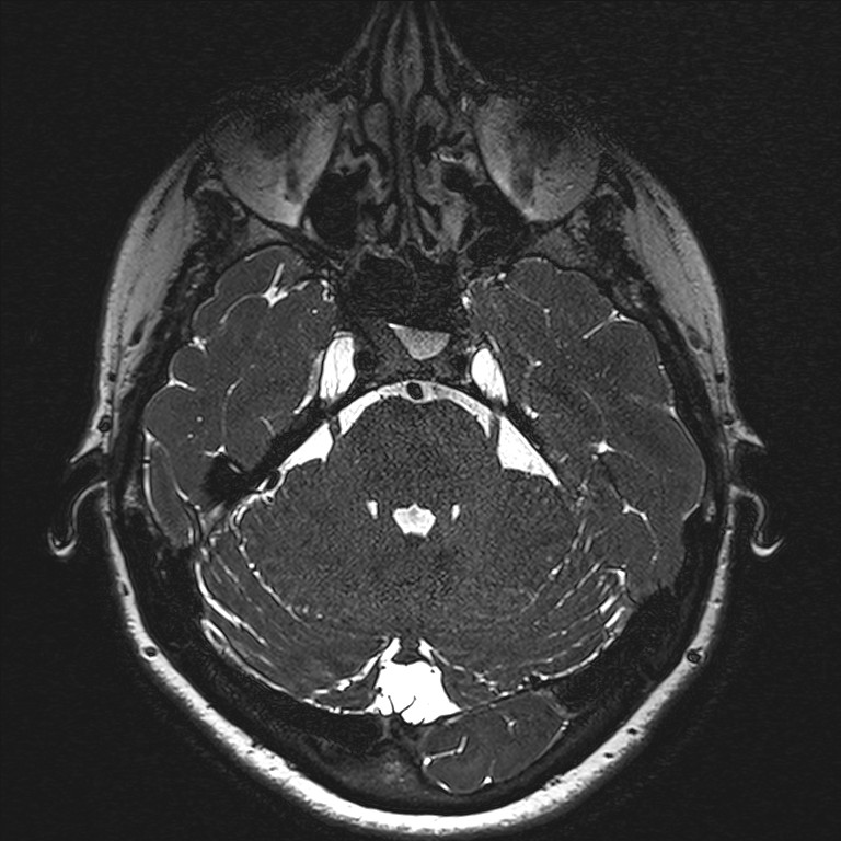 Anterior temporal encephalocele (Radiopaedia 82624-96808 Axial T2 high res 38).jpg