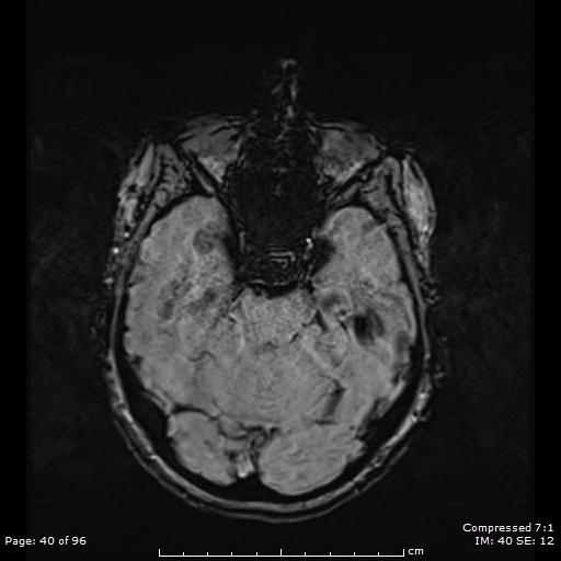 File:Anterior temporal lobe perivascular space (Radiopaedia 88283-104914 Axial SWI 9).jpg