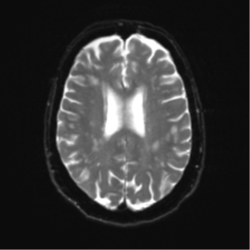 Anterior temporal pole cysts (Radiopaedia 46629-51102 Axial DWI 18).png